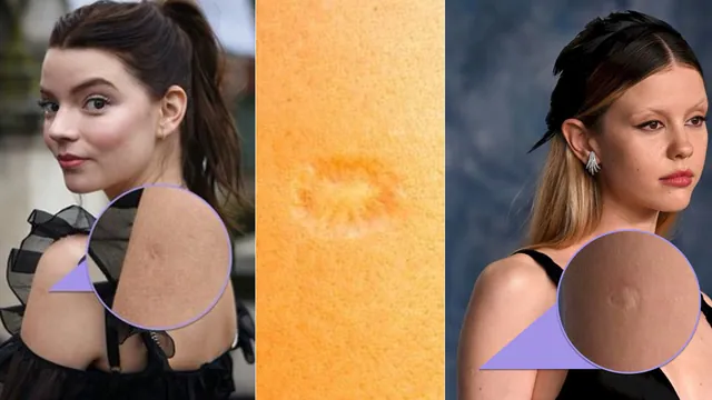 Carte meme BCG TB Vaccine Scar / Immigrant Shot Scar