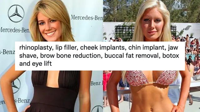 Rhinoplasty, Lip Filler, Cheek Implants, Chin Implant, Jaw Shave meme card