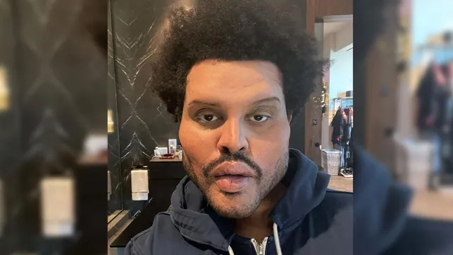 The Weeknd's Plastic Surgery Face meme card